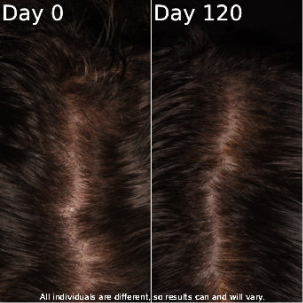 Hair density comparison between day 0 and day 120