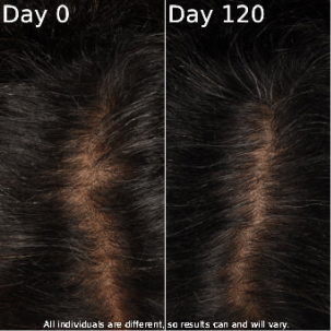Hair density result comparison with day 0 and day 120