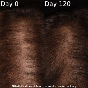 Customer day 0 and day 120 hair comparison