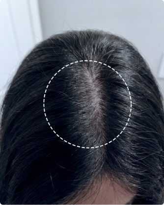 Crown density after the protocol