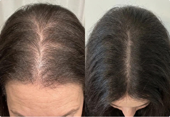 Lauren R. before and after