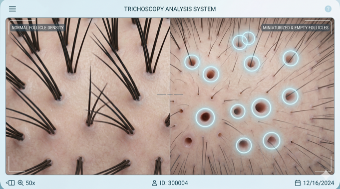 Trichoscopy analysis system comparing normal follicle density with miniaturized and empty follicles