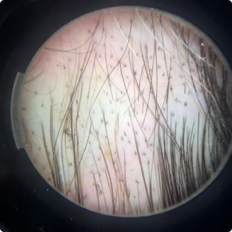 Trichoscopy at week 0